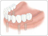 インプラントと入歯の例