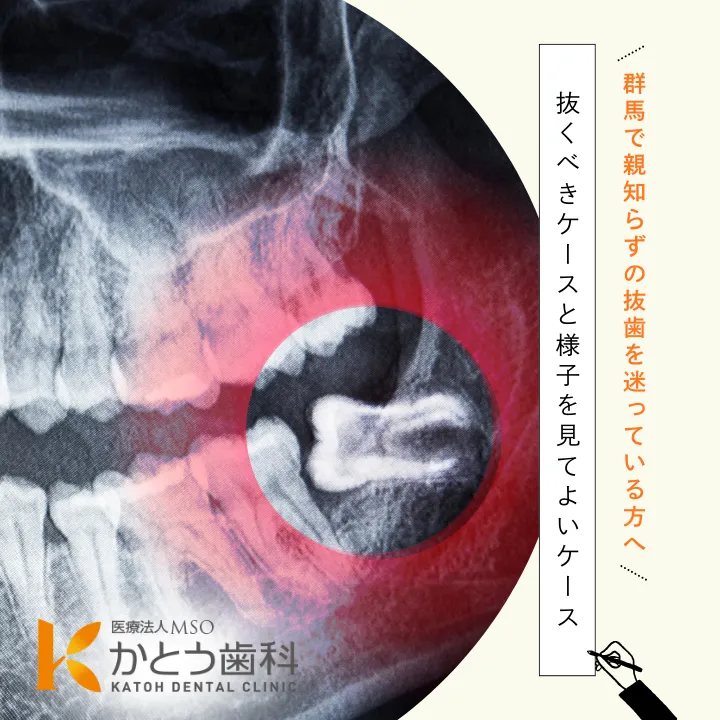2025年10月31日_群馬で親知らずの抜歯を迷っている方へ|抜くべきケースと様子を見てよいケース