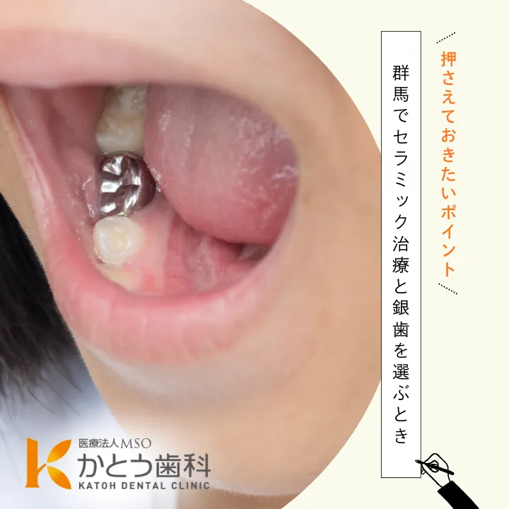 2025年12月26日_群馬でセラミック治療と銀歯を選ぶときに押さえておきたいポイント