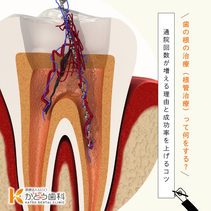 2026年3月20日_歯の根の治療(根管治療)って何をする?|通院回数が増える理由と成功率を上げるコツ