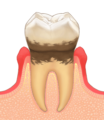 軽度歯周炎